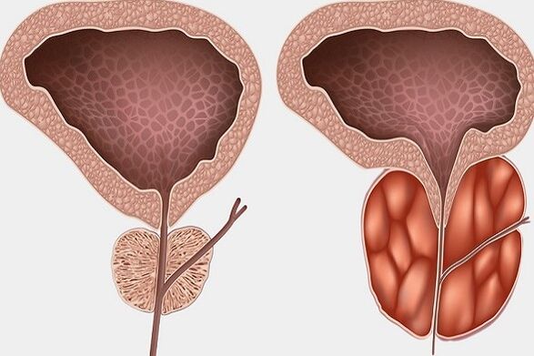 Upala prostate