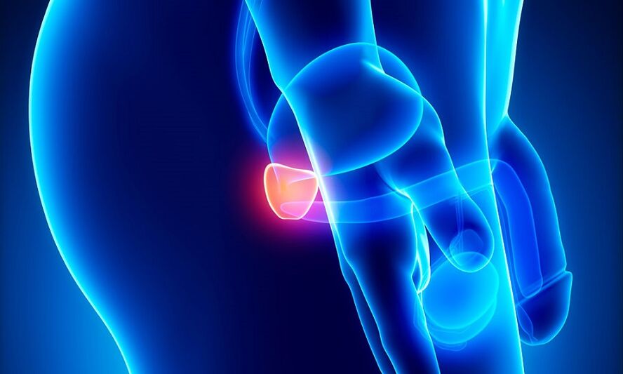Upala prostate s prostatitisom