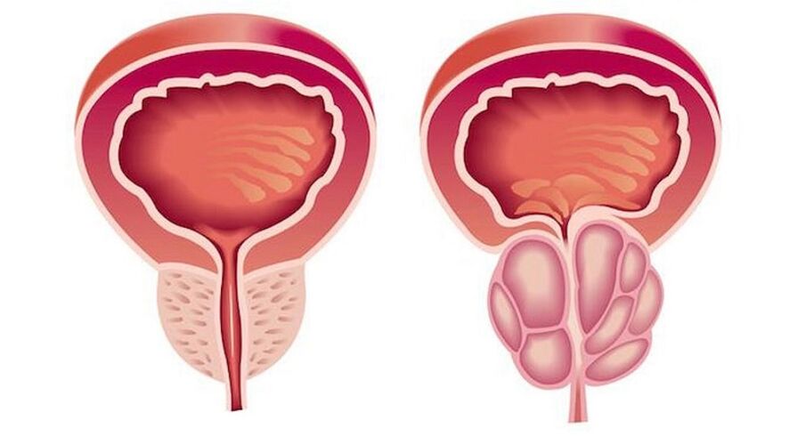 Zdrava i upaljena prostata s prostatitisom